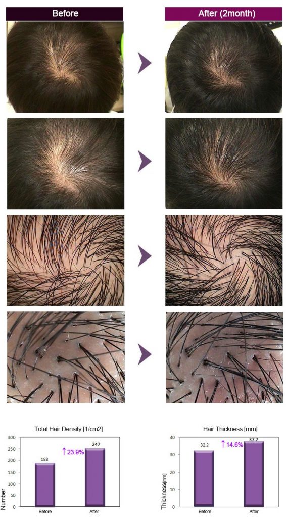 Protocolo de aplicación de Dr. CyJ Hair Filler Protocolo de aplicación de Dr. CyJ Hair Filler